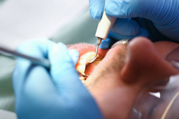 Best Emergency Root Canal Treatment in Murphysboro, IL